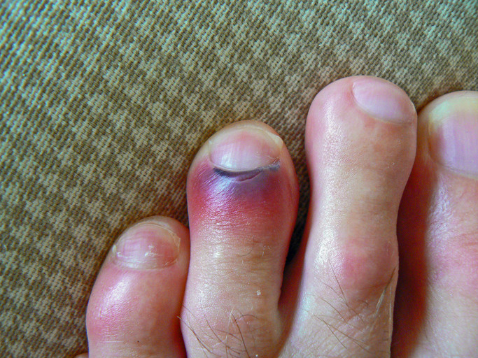 Blue Toenail: Causes, Treatment, and More - wide 7